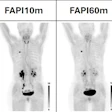 PET/CT images performed at 10- and 60-minutes following injection of Ga-68 FAPI-46 (mean 181 MBq; range 143–225 MBq).