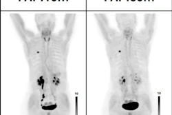 PET/CT images performed at 10- and 60-minutes following injection of Ga-68 FAPI-46 (mean 181 MBq; range 143–225 MBq).