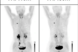 PET/CT images performed at 10- and 60-minutes following injection of Ga-68 FAPI-46 (mean 181 MBq; range 143–225 MBq).
