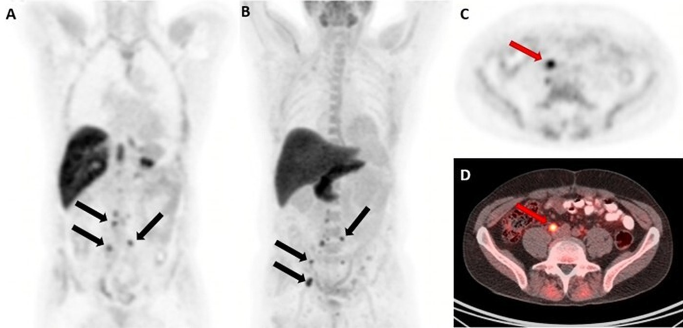 F-18 fluciclovine PET/CT images in a 59-year-old man with biochemical recurrence after prostatectomy (prostate-specific antigen level, 0.42 ng/mL; Gleason score, 5 + 4 = 9; T3BN1M0). (A) Coronal PET and (B) maximum intensity projection images show multiple retroperitoneal lymph nodes with abnormal radiotracer uptake (arrows). (C) Axial PET and (D) axial fused PET/CT images show the index lesion (arrow), measuring 13 &times; 10 mm, on the right precaval lymph node. The initial decision to offer radiation therapy to the prostate bed and pelvis was changed to a decision not to offer radiation therapy.