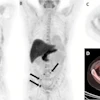 F-18 fluciclovine PET/CT images in a 59-year-old man with biochemical recurrence after prostatectomy (prostate-specific antigen level, 0.42 ng/mL; Gleason score, 5 + 4 = 9; T3BN1M0). (A) Coronal PET and (B) maximum intensity projection images show multiple retroperitoneal lymph nodes with abnormal radiotracer uptake (arrows). (C) Axial PET and (D) axial fused PET/CT images show the index lesion (arrow), measuring 13 × 10 mm, on the right precaval lymph node. The initial decision to offer radiation therapy to the prostate bed and pelvis was changed to a decision not to offer radiation therapy.