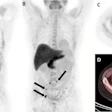 F-18 fluciclovine PET/CT images in a 59-year-old man with biochemical recurrence after prostatectomy (prostate-specific antigen level, 0.42 ng/mL; Gleason score, 5 + 4 = 9; T3BN1M0). (A) Coronal PET and (B) maximum intensity projection images show multiple retroperitoneal lymph nodes with abnormal radiotracer uptake (arrows). (C) Axial PET and (D) axial fused PET/CT images show the index lesion (arrow), measuring 13 × 10 mm, on the right precaval lymph node. The initial decision to offer radiation therapy to the prostate bed and pelvis was changed to a decision not to offer radiation therapy.