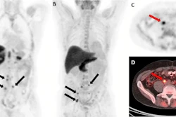 F-18 fluciclovine PET/CT images in a 59-year-old man with biochemical recurrence after prostatectomy (prostate-specific antigen level, 0.42 ng/mL; Gleason score, 5 + 4 = 9; T3BN1M0). (A) Coronal PET and (B) maximum intensity projection images show multiple retroperitoneal lymph nodes with abnormal radiotracer uptake (arrows). (C) Axial PET and (D) axial fused PET/CT images show the index lesion (arrow), measuring 13 × 10 mm, on the right precaval lymph node. The initial decision to offer radiation therapy to the prostate bed and pelvis was changed to a decision not to offer radiation therapy.