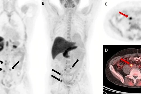 F-18 fluciclovine PET/CT images in a 59-year-old man with biochemical recurrence after prostatectomy (prostate-specific antigen level, 0.42 ng/mL; Gleason score, 5 + 4 = 9; T3BN1M0). (A) Coronal PET and (B) maximum intensity projection images show multiple retroperitoneal lymph nodes with abnormal radiotracer uptake (arrows). (C) Axial PET and (D) axial fused PET/CT images show the index lesion (arrow), measuring 13 × 10 mm, on the right precaval lymph node. The initial decision to offer radiation therapy to the prostate bed and pelvis was changed to a decision not to offer radiation therapy.