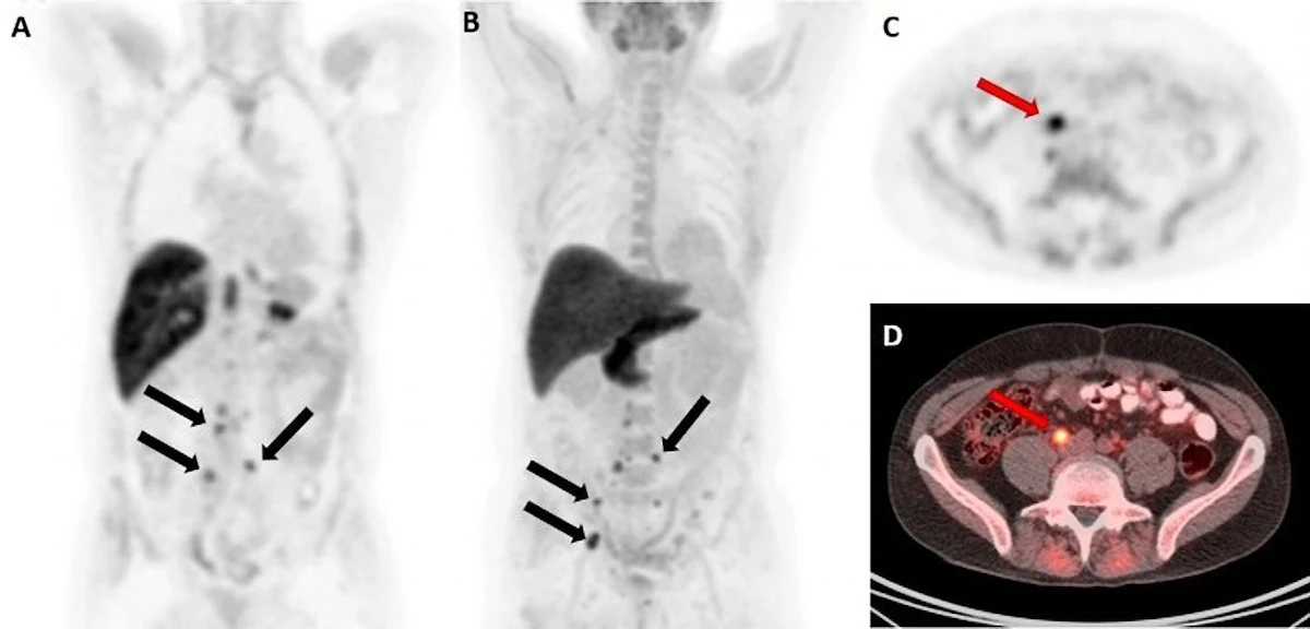 PET/CT guides treatment in men with recurrent prostate cancer