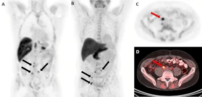 F-18 fluciclovine PET/CT images in a 59-year-old man with biochemical recurrence after prostatectomy (prostate-specific antigen level, 0.42 ng/mL; Gleason score, 5 + 4 = 9; T3BN1M0). (A) Coronal PET and (B) maximum intensity projection images show multiple retroperitoneal lymph nodes with abnormal radiotracer uptake (arrows). (C) Axial PET and (D) axial fused PET/CT images show the index lesion (arrow), measuring 13 × 10 mm, on the right precaval lymph node. The initial decision to offer radiation therapy to the prostate bed and pelvis was changed to a decision not to offer radiation therapy.