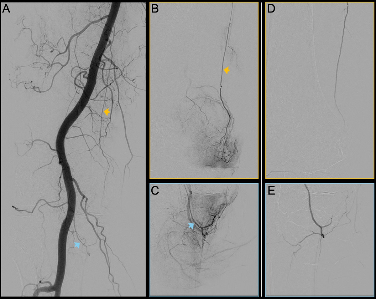 Digital subtraction angiography images of the right knee joint of a 62-year-old participant with predominantly medial knee osteoarthritis. (A) Peri-interventional image of the popliteal artery. Yellow arrow indicates the descending genicular artery, and blue arrow indicates the medial inferior genicular artery. (B, C) Selective preinterventional images show hypervascularity of two branches of the genicular artery: the (B) descending genicular artery (arrow) and the (C) medial inferior genicular artery (arrow). (D, E) Selective postinterventional images obtained after embolization with rapidly resorbable gelatin-based microspheres. Complete elimination of the blush is observed, with preserved perfusion of the proximal arterial segments.