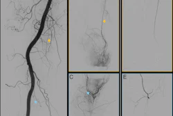 Digital subtraction angiography images of the right knee joint of a 62-year-old participant with predominantly medial knee osteoarthritis. (A) Peri-interventional image of the popliteal artery. Yellow arrow indicates the descending genicular artery, and blue arrow indicates the medial inferior genicular artery. (B, C) Selective preinterventional images show hypervascularity of two branches of the genicular artery: the (B) descending genicular artery (arrow) and the (C) medial inferior genicular artery (arrow). (D, E) Selective postinterventional images obtained after embolization with rapidly resorbable gelatin-based microspheres. Complete elimination of the blush is observed, with preserved perfusion of the proximal arterial segments.