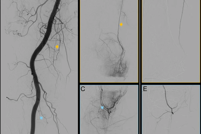 Digital subtraction angiography images of the right knee joint of a 62-year-old participant with predominantly medial knee osteoarthritis. (A) Peri-interventional image of the popliteal artery. Yellow arrow indicates the descending genicular artery, and blue arrow indicates the medial inferior genicular artery. (B, C) Selective preinterventional images show hypervascularity of two branches of the genicular artery: the (B) descending genicular artery (arrow) and the (C) medial inferior genicular artery (arrow). (D, E) Selective postinterventional images obtained after embolization with rapidly resorbable gelatin-based microspheres. Complete elimination of the blush is observed, with preserved perfusion of the proximal arterial segments.
