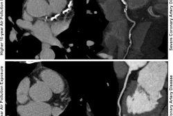 Coronary imaging comparison: CACS and CTA scans showing severe calcium deposits with higher plaque exposure versus no coronary artery disease with lower plaque exposure