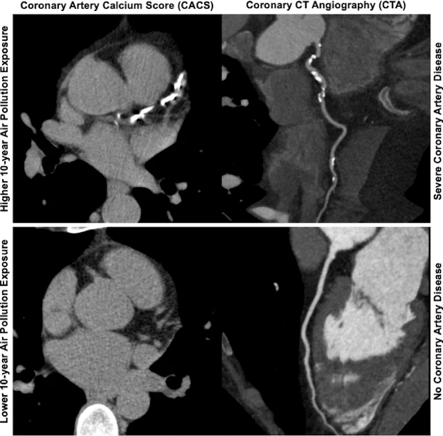 Air pollution tied to worse coronary disease on CT, especially in women