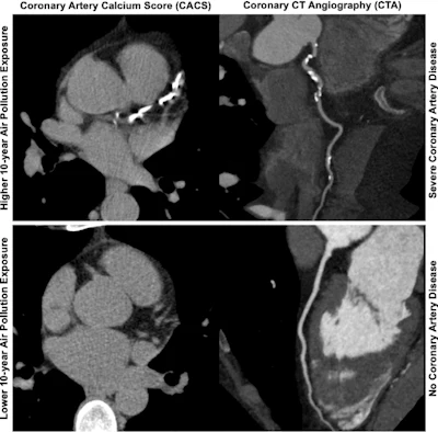 Axial images from unenhanced calcium score cardiac CT (left) and curved planar reformation images from CT angiography (right) show that higher long-term exposure to air pollution is associated with greater coronary artery calcium and more obstructive coronary artery disease (CAD). Top row: Images in a 68-year-old male patient with higher 10-year mean ambient air pollution exposure (7.9 μg/m3 for particulate matter measuring ≤2.5 μm in diameter [PM2.5] and 17.4 parts per billion [ppb] for NO2) with extensive CAD (coronary artery calcium score [CACS] >1,000 and obstructive CAD [≥70% diameter stenosis]). Bottom row: Images in a 57-year-old female patient with lower 10-year mean ambient air pollution exposure (6.3 μg/m3 for PM2.5 and 4.6 ppb for NO2) with no CAD (CACS = 0 and no obstructive stenosis).