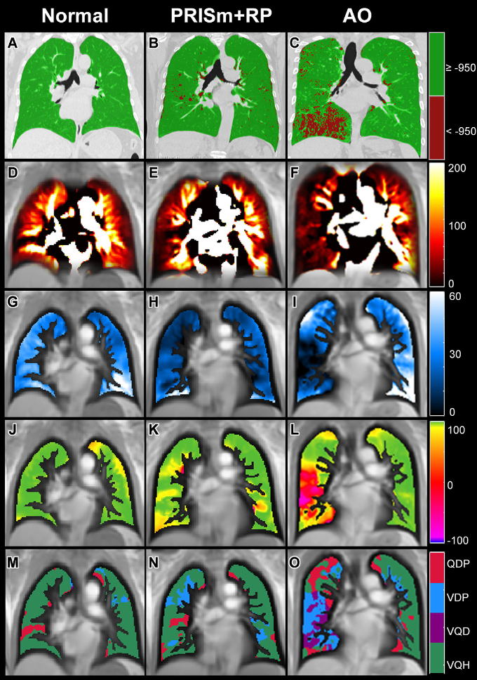 Caption: Representative images show emphysema and functional lung maps derived by CT and PREFUL-MRI: (A&ndash;C) CT-derived emphysema images, (D&ndash;F) perfusion maps, (G&ndash;I) regional ventilation maps, (J&ndash;L) flow-volume loop correlation metric maps, (M&ndash;O) ventilation/perfusion combined parameter maps. (A, D, G, J, M) Images in a 63-year-old male with normal spirometry: FEV1%pred = 89.0%, FEV1/FVC = 0.73; emphysema percentage = 0.2%, QDP = 7%, VDPRVent = 2%, VDPFVL-CM = 1%. (B, E, H, K, N) Images in a 65-year-old female with PRISm + RP: FEV1%pred = 71.2%, FVC %pred = 76.8%, FEV1/FVC = 0.76; emphysema percentage = 4.7%, QDP = 10%, VD-PRVent = 18%, VDPFVL-CM = 6%. (C, F, I, L, O) Images in a 57-year-old male with AO: FEV1%pred = 56.8%, FEV1/FVC = 0.52; emphysema = 11.1%, QDP = 31%, VDPRVent = 33%, VDPFVL-CM = 41%. AO = airflow obstruction, FEV1 = forced expiratory volume in 1 second, FVC = forced vital capacity, FVL-CM = flow-volume loop correlation metric, %pred = percent predicted, PREFUL = phase-resolved function lung, PRISm = preserved ratio impaired spirometry, QDP = perfusion defect percentage, RVent = regional ventilation, VDP = ventilation defect percentage.