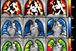 Caption: Representative images show emphysema and functional lung maps derived by CT and PREFUL-MRI: (A–C) CT-derived emphysema images, (D–F) perfusion maps, (G–I) regional ventilation maps, (J–L) flow-volume loop correlation metric maps, (M–O) ventilation/perfusion combined parameter maps. (A, D, G, J, M) Images in a 63-year-old male with normal spirometry: FEV1%pred = 89.0%, FEV1/FVC = 0.73; emphysema percentage = 0.2%, QDP = 7%, VDPRVent = 2%, VDPFVL-CM = 1%. (B, E, H, K, N) Images in a 65-year-old female with PRISm + RP: FEV1%pred = 71.2%, FVC %pred = 76.8%, FEV1/FVC = 0.76; emphysema percentage = 4.7%, QDP = 10%, VD-PRVent = 18%, VDPFVL-CM = 6%. (C, F, I, L, O) Images in a 57-year-old male with AO: FEV1%pred = 56.8%, FEV1/FVC = 0.52; emphysema = 11.1%, QDP = 31%, VDPRVent = 33%, VDPFVL-CM = 41%. AO = airflow obstruction, FEV1 = forced expiratory volume in 1 second, FVC = forced vital capacity, FVL-CM = flow-volume loop correlation metric, %pred = percent predicted, PREFUL = phase-resolved function lung, PRISm = preserved ratio impaired spirometry, QDP = perfusion defect percentage, RVent = regional ventilation, VDP = ventilation defect percentage.