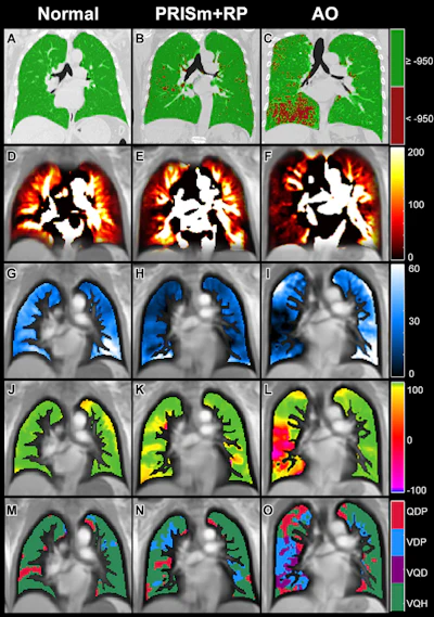 Caption: Representative images show emphysema and functional lung maps derived by CT and PREFUL-MRI: (A–C) CT-derived emphysema images, (D–F) perfusion maps, (G–I) regional ventilation maps, (J–L) flow-volume loop correlation metric maps, (M–O) ventilation/perfusion combined parameter maps. (A, D, G, J, M) Images in a 63-year-old male with normal spirometry: FEV1%pred = 89.0%, FEV1/FVC = 0.73; emphysema percentage = 0.2%, QDP = 7%, VDPRVent = 2%, VDPFVL-CM = 1%. (B, E, H, K, N) Images in a 65-year-old female with PRISm + RP: FEV1%pred = 71.2%, FVC %pred = 76.8%, FEV1/FVC = 0.76; emphysema percentage = 4.7%, QDP = 10%, VD-PRVent = 18%, VDPFVL-CM = 6%. (C, F, I, L, O) Images in a 57-year-old male with AO: FEV1%pred = 56.8%, FEV1/FVC = 0.52; emphysema = 11.1%, QDP = 31%, VDPRVent = 33%, VDPFVL-CM = 41%. AO = airflow obstruction, FEV1 = forced expiratory volume in 1 second, FVC = forced vital capacity, FVL-CM = flow-volume loop correlation metric, %pred = percent predicted, PREFUL = phase-resolved function lung, PRISm = preserved ratio impaired spirometry, QDP = perfusion defect percentage, RVent = regional ventilation, VDP = ventilation defect percentage.