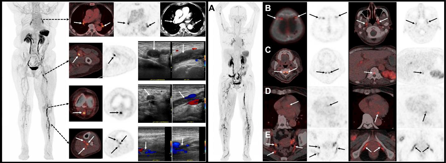 (Left) F-18 GP1 PET/CT images from a 75-year-old woman show multiple blood clots in the deep veins of the left leg (from the thigh to the calf), as well as several clots in the right calf. Venous ultrasound confirms blood clots in left thigh, knee and calf veins. PET/CT also detects clots in both lungs, which are confirmed by contrast-enhanced CT image. (Right) 18F-GP1 PET/CT images from a 70-year-old woman show widespread blood clots throughout the body. In addition to clots in the deep veins of both legs and the arteries of both lungs (A), the scan also detected unexpected clots in several other areas, including blood vessels near the skull/head (B), spine (C), heart (D), and pelvis (E). Further evaluation revealed that the patient had antiphospholipid syndrome, an autoimmune condition that increases the risk of abnormal blood clot formation.