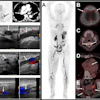 (Left) F-18 GP1 PET/CT images from a 75-year-old woman show multiple blood clots in the deep veins of the left leg (from the thigh to the calf), as well as several clots in the right calf. Venous ultrasound confirms blood clots in left thigh, knee and calf veins. PET/CT also detects clots in both lungs, which are confirmed by contrast-enhanced CT image. (Right) 18F-GP1 PET/CT images from a 70-year-old woman show widespread blood clots throughout the body. In addition to clots in the deep veins of both legs and the arteries of both lungs (A), the scan also detected unexpected clots in several other areas, including blood vessels near the skull/head (B), spine (C), heart (D), and pelvis (E). Further evaluation revealed that the patient had antiphospholipid syndrome, an autoimmune condition that increases the risk of abnormal blood clot formation.