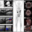 (Left) F-18 GP1 PET/CT images from a 75-year-old woman show multiple blood clots in the deep veins of the left leg (from the thigh to the calf), as well as several clots in the right calf. Venous ultrasound confirms blood clots in left thigh, knee and calf veins. PET/CT also detects clots in both lungs, which are confirmed by contrast-enhanced CT image. (Right) 18F-GP1 PET/CT images from a 70-year-old woman show widespread blood clots throughout the body. In addition to clots in the deep veins of both legs and the arteries of both lungs (A), the scan also detected unexpected clots in several other areas, including blood vessels near the skull/head (B), spine (C), heart (D), and pelvis (E). Further evaluation revealed that the patient had antiphospholipid syndrome, an autoimmune condition that increases the risk of abnormal blood clot formation.