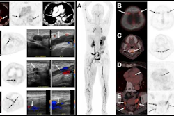 (Left) F-18 GP1 PET/CT images from a 75-year-old woman show multiple blood clots in the deep veins of the left leg (from the thigh to the calf), as well as several clots in the right calf. Venous ultrasound confirms blood clots in left thigh, knee and calf veins. PET/CT also detects clots in both lungs, which are confirmed by contrast-enhanced CT image. (Right) 18F-GP1 PET/CT images from a 70-year-old woman show widespread blood clots throughout the body. In addition to clots in the deep veins of both legs and the arteries of both lungs (A), the scan also detected unexpected clots in several other areas, including blood vessels near the skull/head (B), spine (C), heart (D), and pelvis (E). Further evaluation revealed that the patient had antiphospholipid syndrome, an autoimmune condition that increases the risk of abnormal blood clot formation.