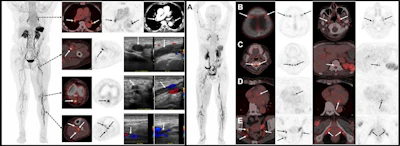 (Left) F-18 GP1 PET/CT images from a 75-year-old woman show multiple blood clots in the deep veins of the left leg (from the thigh to the calf), as well as several clots in the right calf. Venous ultrasound confirms blood clots in left thigh, knee and calf veins. PET/CT also detects clots in both lungs, which are confirmed by contrast-enhanced CT image. (Right) 18F-GP1 PET/CT images from a 70-year-old woman show widespread blood clots throughout the body. In addition to clots in the deep veins of both legs and the arteries of both lungs (A), the scan also detected unexpected clots in several other areas, including blood vessels near the skull/head (B), spine (C), heart (D), and pelvis (E). Further evaluation revealed that the patient had antiphospholipid syndrome, an autoimmune condition that increases the risk of abnormal blood clot formation.