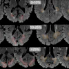 Examples of DAWM on FLAIR MRI slices. Transversal slices of 1.5T FLAIR MRI scans. For visualization only, brains were skull-stripped and DAWM is shown with dotted lines (occipital DAWM is red, parietal DAWM is orange). Top row images (25% of lobar WM) show larger, more confluent configurations of DAWM, extending beyond the slices shown here.