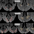 Examples of DAWM on FLAIR MRI slices. Transversal slices of 1.5T FLAIR MRI scans. For visualization only, brains were skull-stripped and DAWM is shown with dotted lines (occipital DAWM is red, parietal DAWM is orange). Top row images (25% of lobar WM) show larger, more confluent configurations of DAWM, extending beyond the slices shown here.