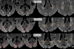 Examples of DAWM on FLAIR MRI slices. Transversal slices of 1.5T FLAIR MRI scans. For visualization only, brains were skull-stripped and DAWM is shown with dotted lines (occipital DAWM is red, parietal DAWM is orange). Top row images (25% of lobar WM) show larger, more confluent configurations of DAWM, extending beyond the slices shown here.