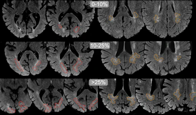 Examples of DAWM on FLAIR MRI slices. Transversal slices of 1.5T FLAIR MRI scans. For visualization only, brains were skull-stripped and DAWM is shown with dotted lines (occipital DAWM is red, parietal DAWM is orange). Top row images (25% of lobar WM) show larger, more confluent configurations of DAWM, extending beyond the slices shown here.