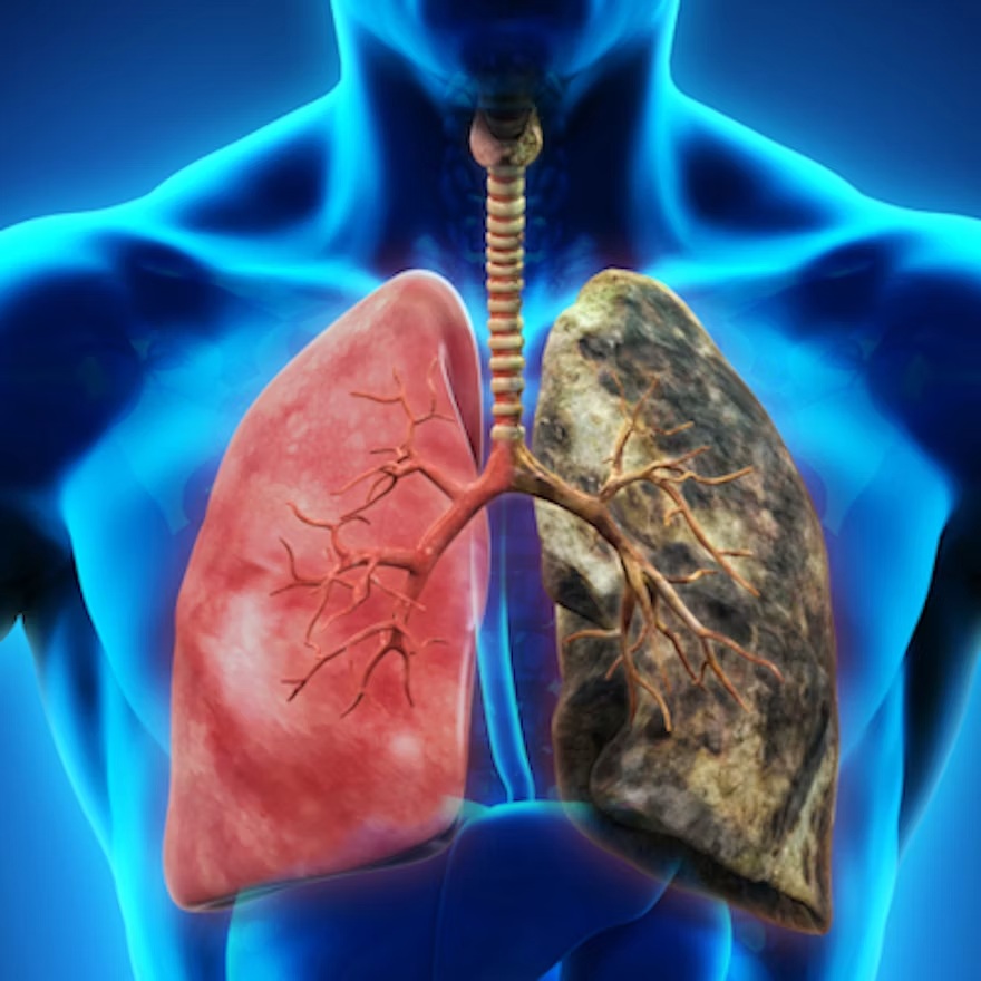 Lung Cancer
