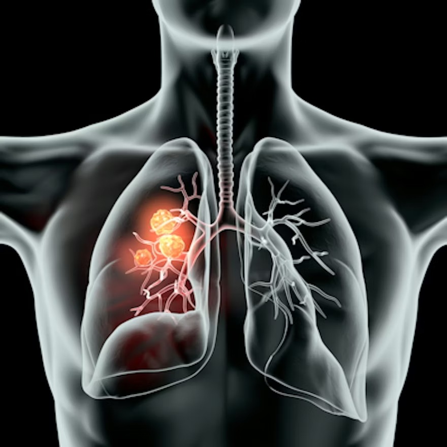 Lung Tumors
