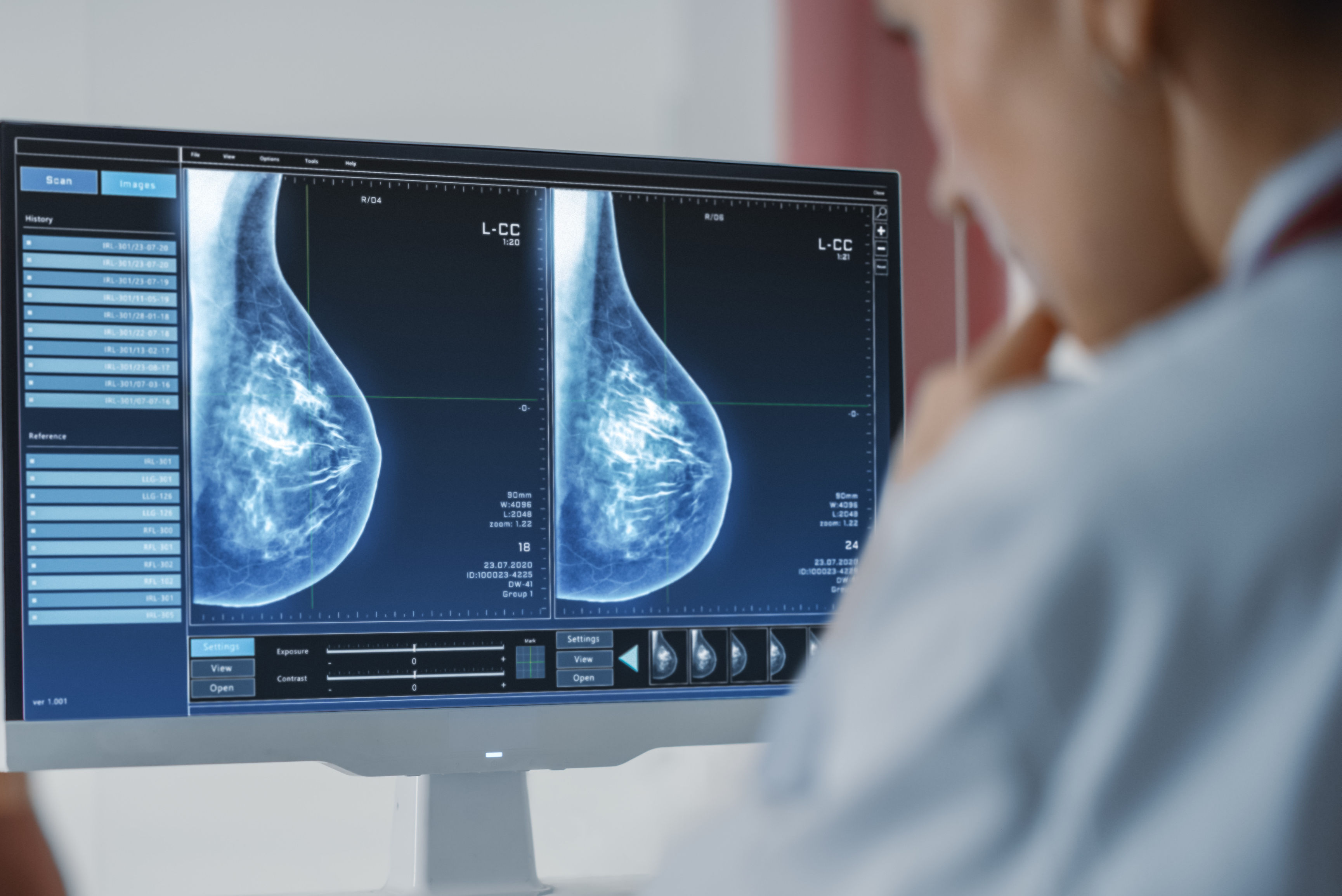 Mammogram Dense Breasts Cropped (1)