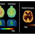 Representative SV2A PET images comparing synaptic density in healthy and disease states. The left panel shows F-18 SynVesT-1 PET distribution volume (VT) maps of the brain and spinal cord in a naïve control mouse and a mouse with experimental autoimmune encephalomyelitis (EAE), a model of multiple sclerosis. The right panel shows Cu-11 UCB-J PET images of the brain of a 46-year-old male healthy control (left) and 43-year-old female MS patient (right).
