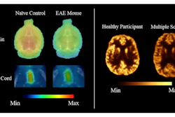 Representative SV2A PET images comparing synaptic density in healthy and disease states. The left panel shows F-18 SynVesT-1 PET distribution volume (VT) maps of the brain and spinal cord in a naïve control mouse and a mouse with experimental autoimmune encephalomyelitis (EAE), a model of multiple sclerosis. The right panel shows Cu-11 UCB-J PET images of the brain of a 46-year-old male healthy control (left) and 43-year-old female MS patient (right).