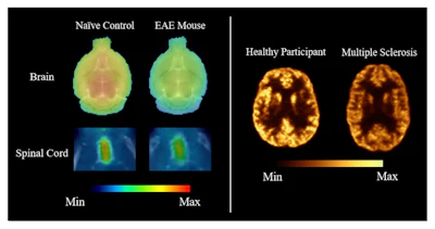 Representative SV2A PET images comparing synaptic density in healthy and disease states. The left panel shows F-18 SynVesT-1 PET distribution volume (VT) maps of the brain and spinal cord in a naïve control mouse and a mouse with experimental autoimmune encephalomyelitis (EAE), a model of multiple sclerosis. The right panel shows Cu-11 UCB-J PET images of the brain of a 46-year-old male healthy control (left) and 43-year-old female MS patient (right).