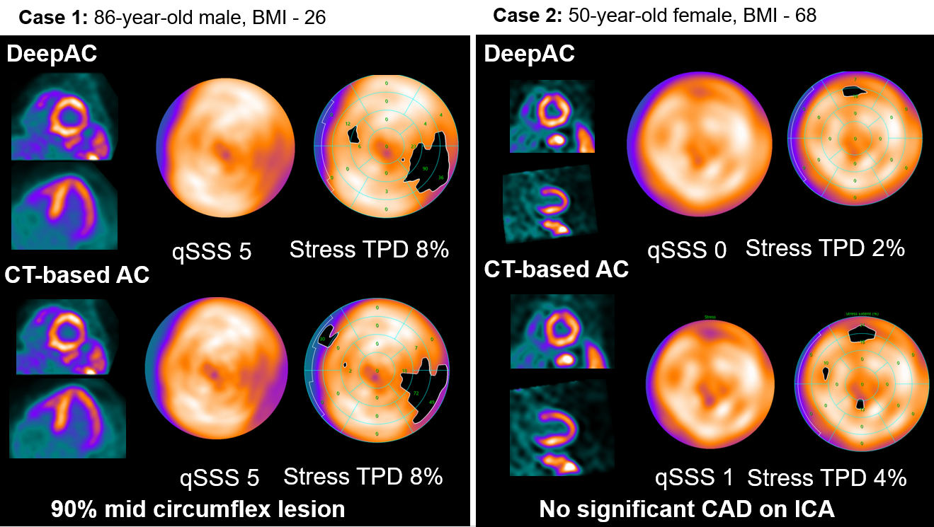 Cardiac stress test imaging comparison showing DeepAC and CT-based attenuation correction scans for two patients with quantitative perfusion data.