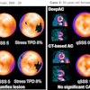 Cardiac stress test imaging comparison showing DeepAC and CT-based attenuation correction scans for two patients with quantitative perfusion data.