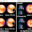 Cardiac stress test imaging comparison showing DeepAC and CT-based attenuation correction scans for two patients with quantitative perfusion data.