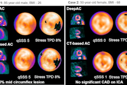 Cardiac stress test imaging comparison showing DeepAC and CT-based attenuation correction scans for two patients with quantitative perfusion data.