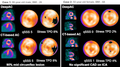 Cardiac stress test imaging comparison showing DeepAC and CT-based attenuation correction scans for two patients with quantitative perfusion data.