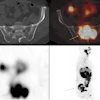 Post-Pluvicto SPECT/CT with axial fused images of sacrum and sagittal maximum intensity projection of one of the patients who complained of increasing pain in the sacral region (arrows) post therapy.
