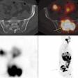 Post-Pluvicto SPECT/CT with axial fused images of sacrum and sagittal maximum intensity projection of one of the patients who complained of increasing pain in the sacral region (arrows) post therapy.