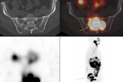 Post-Pluvicto SPECT/CT with axial fused images of sacrum and sagittal maximum intensity projection of one of the patients who complained of increasing pain in the sacral region (arrows) post therapy.
