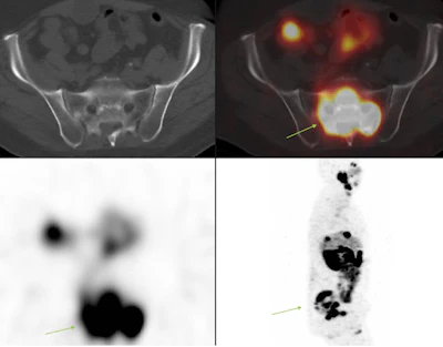 Post-Pluvicto SPECT/CT with axial fused images of sacrum and sagittal maximum intensity projection of one of the patients who complained of increasing pain in the sacral region (arrows) post therapy.