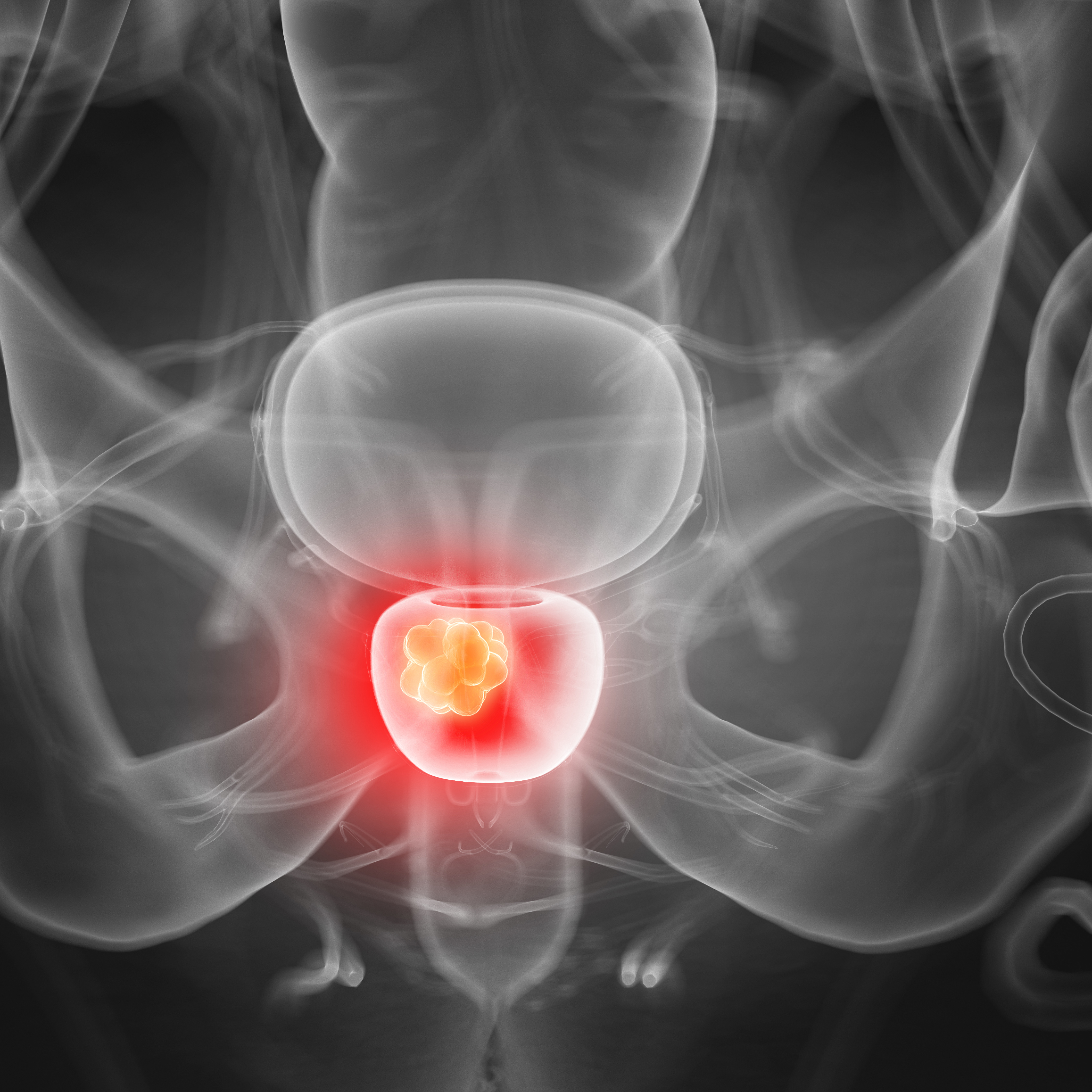 Prostate 3 D