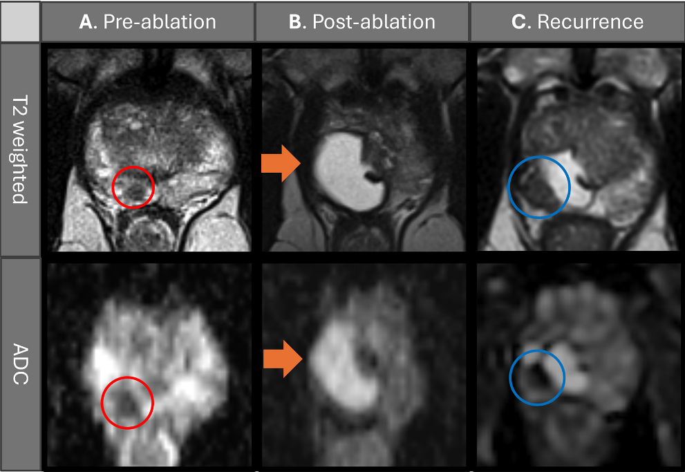 Preablation, postablation, and recurrence multiparametric MRI scans depict a 63-year-old man treated with transperineal focal laser ablation (TPLA) for localized prostate cancer. Clinical parameters included an initial prostate-specific antigen (PSA) level of 7.2 ng/mL, a Prostate Imaging Reporting and Data System (PI-RADS) grade 4 lesion (red circles) in the right apical peripheral zone, and a maximum tumor length of 5 mm. MRI-guided targeted biopsy confirmed a Gleason score 3+4 prostate cancer tumor. (A) Pre-ablation axial T2-weighted MRI scan and apparent diffusion coefficient (ADC) image shows the apical PI-RADS 4 lesion (circles). (B) Six-month post-ablation axial T2-weighted MRI scan and ADC image show cystic necrosis (arrows). There was no evidence of recurrence; the PSA level was 1.5 ng/mL. (C) One-year after ablation, the patient&rsquo;s PSA level had increased to 4.3 ng/mL. Axial T2-weighted MRI scan and the ADC image shows a recurrent lesion (blue circles) in the right apical peripheral zone adjacent to the ablation scar. Targeted biopsy confirmed Gleason score 3+4 prostate cancer, which was classified as in-field recurrence of clinically significant prostate cancer and subsequently re-treated with TPLA. In summary, serial multiplanar MRI demonstrates treatment response after TPLA with post-ablation necrosis, followed by MRI-detected IFR confirmed with biopsy at 12-month follow-up. Multiparametric MRI was performed with a 3.0-T MRI scanner (Skyra; Siemens Healthineers) using T2-weighted, diffusion-weighted, and ADC sequences, with gadobenate dimeglumine contrast material administration (Bracco Diagnostics).