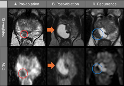 Preablation, postablation, and recurrence multiparametric MRI scans depict a 63-year-old man treated with transperineal focal laser ablation (TPLA) for localized prostate cancer. Clinical parameters included an initial prostate-specific antigen (PSA) level of 7.2 ng/mL, a Prostate Imaging Reporting and Data System (PI-RADS) grade 4 lesion (red circles) in the right apical peripheral zone, and a maximum tumor length of 5 mm. MRI-guided targeted biopsy confirmed a Gleason score 3+4 prostate cancer tumor. (A) Pre-ablation axial T2-weighted MRI scan and apparent diffusion coefficient (ADC) image shows the apical PI-RADS 4 lesion (circles). (B) Six-month post-ablation axial T2-weighted MRI scan and ADC image show cystic necrosis (arrows). There was no evidence of recurrence; the PSA level was 1.5 ng/mL. (C) One-year after ablation, the patient’s PSA level had increased to 4.3 ng/mL. Axial T2-weighted MRI scan and the ADC image shows a recurrent lesion (blue circles) in the right apical peripheral zone adjacent to the ablation scar. Targeted biopsy confirmed Gleason score 3+4 prostate cancer, which was classified as in-field recurrence of clinically significant prostate cancer and subsequently re-treated with TPLA. In summary, serial multiplanar MRI demonstrates treatment response after TPLA with post-ablation necrosis, followed by MRI-detected IFR confirmed with biopsy at 12-month follow-up. Multiparametric MRI was performed with a 3.0-T MRI scanner (Skyra; Siemens Healthineers) using T2-weighted, diffusion-weighted, and ADC sequences, with gadobenate dimeglumine contrast material administration (Bracco Diagnostics).