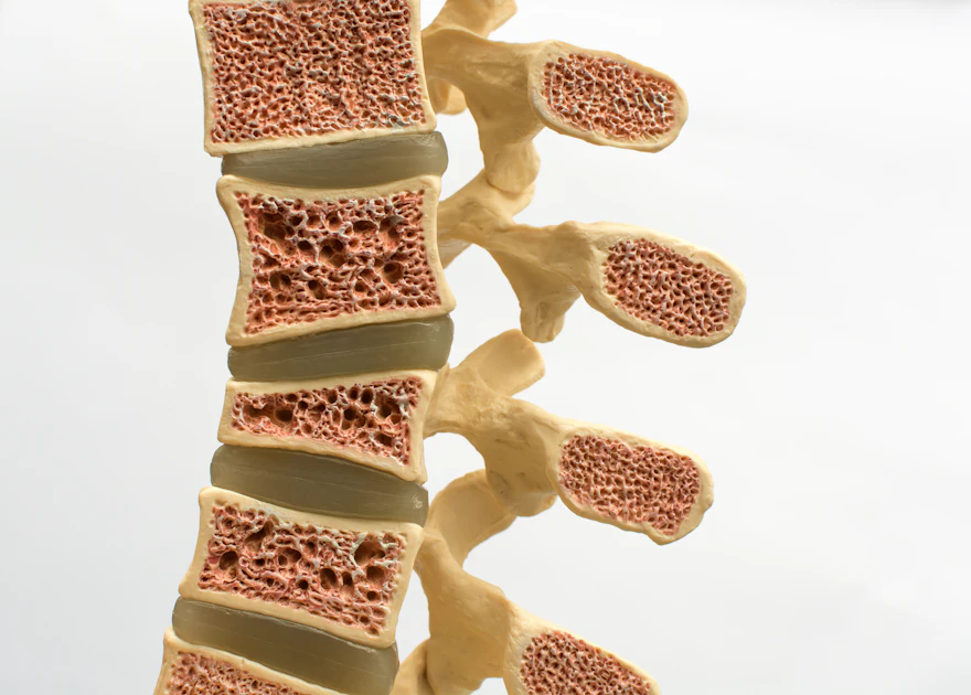 Opportunistic screening can reveal osteoporotic vertebral fractures