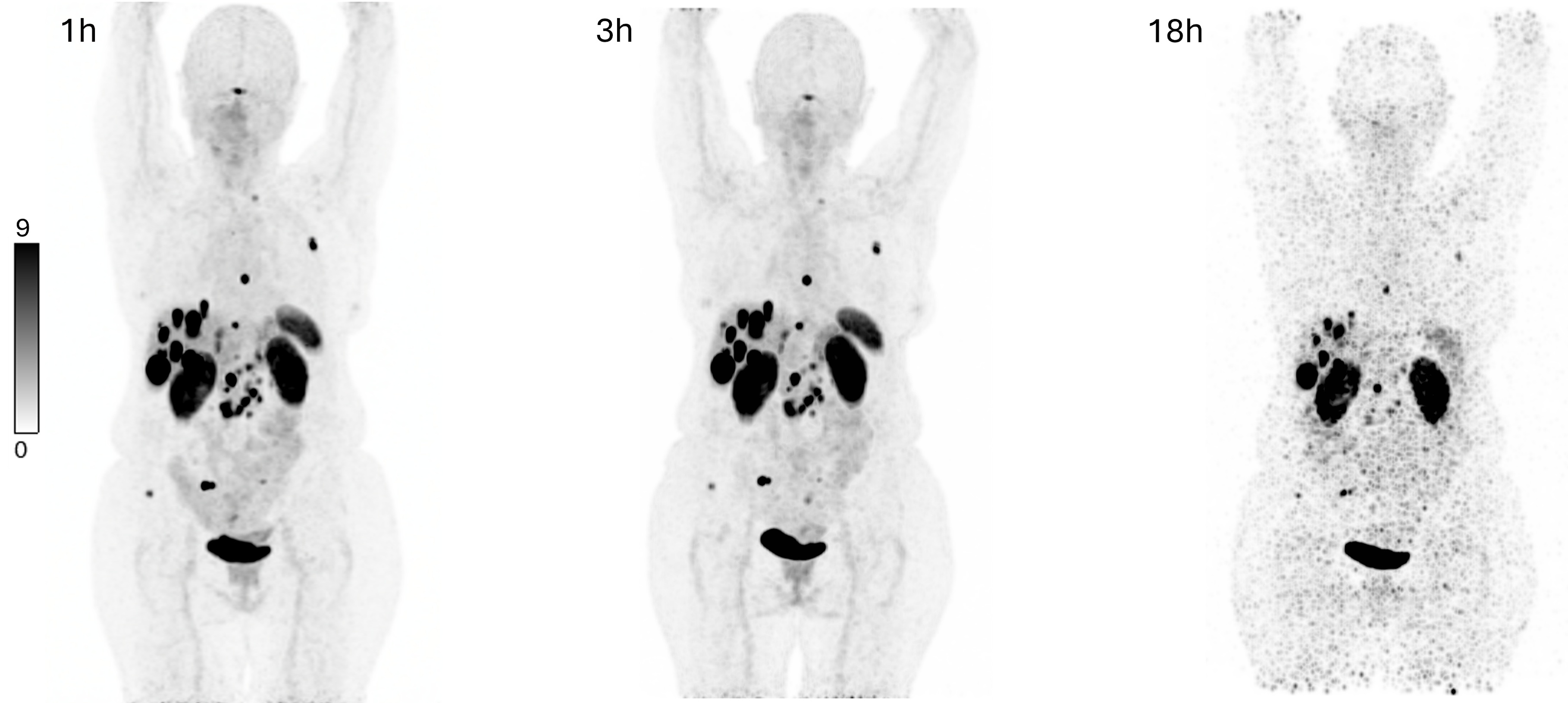 Maximum intensity projections showing biodistribution of Cu-61 NODAGA-LM3 (146 MBq) in a patient with a metastatic non-functional NET of the pancreas G2 (Ki-67: 5%) with lymph node, hepatic, osseous, and peritoneal as well as ovarian metastases. PET performed a 1-hour, 3-hours, and 18-hours post-injection show high and prolonged tumor uptake and excellent image contrast, with low uptake in the liver, intestinal tract, and other non-target organs.