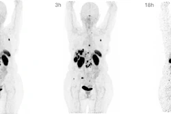 Maximum intensity projections showing biodistribution of Cu-61 NODAGA-LM3 (146 MBq) in a patient with a metastatic non-functional NET of the pancreas G2 (Ki-67: 5%) with lymph node, hepatic, osseous, and peritoneal as well as ovarian metastases. PET performed a 1-hour, 3-hours, and 18-hours post-injection show high and prolonged tumor uptake and excellent image contrast, with low uptake in the liver, intestinal tract, and other non-target organs.