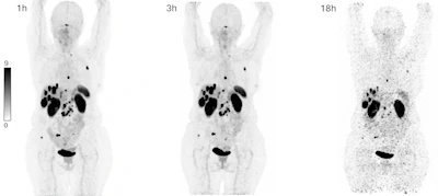 Maximum intensity projections showing biodistribution of Cu-61 NODAGA-LM3 (146 MBq) in a patient with a metastatic non-functional NET of the pancreas G2 (Ki-67: 5%) with lymph node, hepatic, osseous, and peritoneal as well as ovarian metastases. PET performed a 1-hour, 3-hours, and 18-hours post-injection show high and prolonged tumor uptake and excellent image contrast, with low uptake in the liver, intestinal tract, and other non-target organs. Maximum intensity projections showing biodistribution of Cu-61 NODAGA-LM3 (146 MBq) in a patient with a metastatic non-functional NET of the pancreas G2 (Ki-67: 5%) with lymph node, hepatic, osseous, and peritoneal as well as ovarian metastases. PET performed a 1-hour, 3-hours, and 18-hours post-injection show high and prolonged tumor uptake and excellent image contrast, with low uptake in the liver, intestinal tract, and other non-target organs.